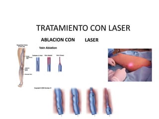 TRATAMIENTO CON LASER
ABLACION CON LASER
 