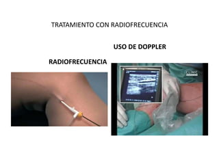 TRATAMIENTO CON RADIOFRECUENCIA
RADIOFRECUENCIA
USO DE DOPPLER
 