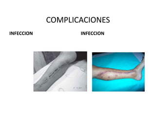 COMPLICACIONES
INFECCION INFECCION
 