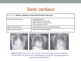 Insuficiencia aortica | PPTX