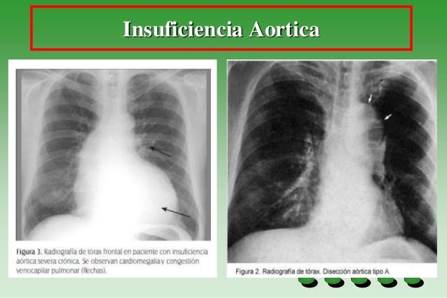 Insuficiencia aortica
