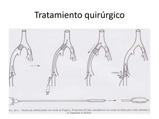 Tratamiento quirúrgico