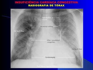 INSUFICIÊNCIA CARDÍACA CONGESTIVAINSUFICIÊNCIA CARDÍACA CONGESTIVA
RADIOGRAFIA DE TÓRAXRADIOGRAFIA DE TÓRAX
Prof. Marco Aguiar (UPE)
 