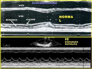 ECOCARDIOGRAMAECOCARDIOGRAMA
NORMANORMA
LL
ICIC
DISFUNÇÃODISFUNÇÃO
SISTÓLICASISTÓLICA
Prof. Marco Aguiar (UPE)
 