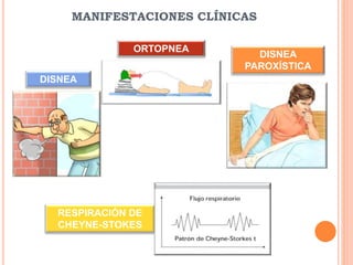 MANIFESTACIONES CLÍNICAS
DISNEA
ORTOPNEA
DISNEA
PAROXÍSTICA
RESPIRACIÓN DE
CHEYNE-STOKES
 