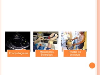 Ecocardiograma
Marcadores
Biológicos
Prueba de
esfuerzo
 