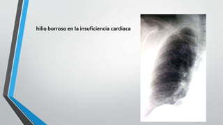 hilio borroso en la insuficiencia cardiaca
 