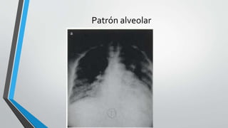 Patrón alveolar
 