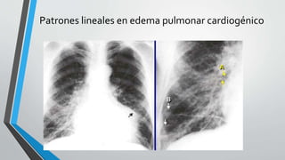 Patrones lineales en edema pulmonar cardiogénico
 