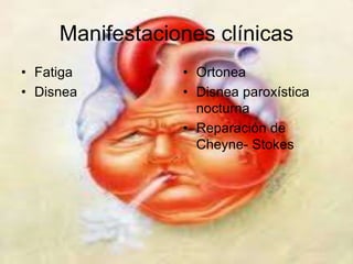 Manifestaciones clínicas 
• Fatiga 
• Disnea 
• Ortonea 
• Disnea paroxística 
nocturna 
• Reparación de 
Cheyne- Stokes 
 