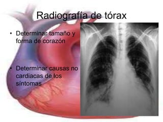 Radiografía de tórax 
• Determinar tamaño y 
forma de corazón 
• Determinar causas no 
cardiacas de los 
síntomas 
 