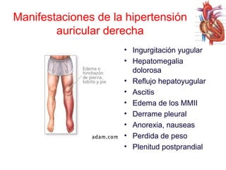 Manifestaciones de la hipertensión
auricular derecha
• Ingurgitación yugular
• Hepatomegalia
dolorosa
• Reflujo hepatoyugular
• Ascitis
• Edema de los MMII
• Derrame pleural
• Anorexia, nauseas
• Perdida de peso
• Plenitud postprandial

 