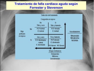 Tratamiento de falla cardiaca aguda según
Forrester y Stevenson

Jessup,M.Brozena,S.Heart failure.NEJM.Mayo 15,2003

 