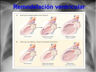 Remodelación ventricular

 