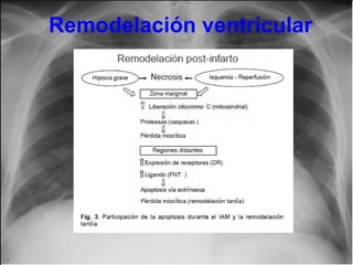 Remodelación ventricular

 