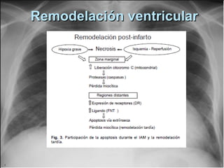 Remodelación ventricularRemodelación ventricular
 