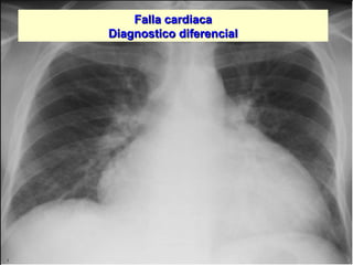 Jessup,M.Brozena,S.Heart failure.NEJM.Mayo 15,2003
Falla cardiacaFalla cardiaca
Diagnostico diferencialDiagnostico diferencial
 