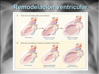 Remodelación ventricularRemodelación ventricular
 
