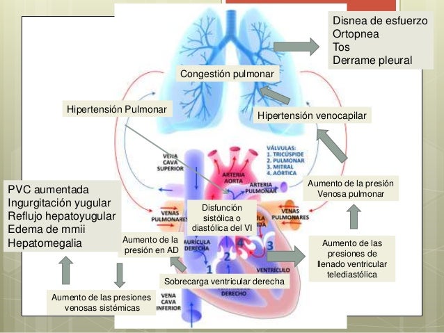 Insuficiencia cardiaca congestiva Insuficiencia cardiaca congestiva
