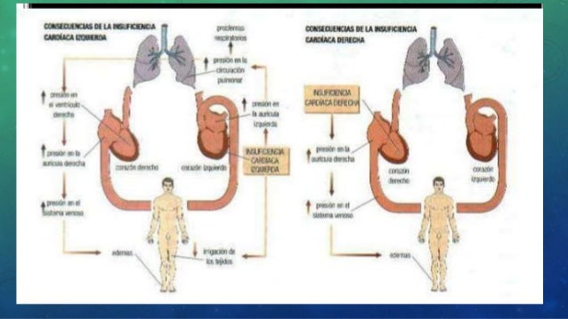 Insuficiencia Cardiaca Izquierda Y Derecha Insuficiencia Cardiaca Izquierda Y Derecha