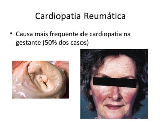 Cardiopatia Reumática
• Causa mais frequente de cardiopatia na
gestante (50% dos casos)
 