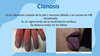 Insuficiencia cardiaca Ulises Reyes Fisiopatologia.pdf