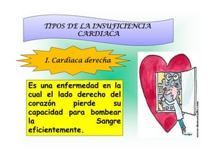 TIPOS DE LA INSUFICIENCIA
            CARDIACA



    I.
    I Cardiaca derecha



Es una enfermedad en la
cual el lado derecho del
corazón     pierde     su
capacidad para bombear
la                 Sangre
eficientemente.
 