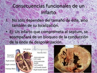 Consecuencias funcionales de un
infarto
I. No sólo dependen del tamaño de éste, sino
también de su localización.
• Ej: Un infarto que comprometa al septum, se
acompañará de un bloqueo de la conducción
de la onda de despolarización.
 
