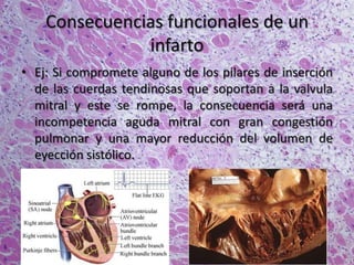 Consecuencias funcionales de un
infarto
• Ej: Si compromete alguno de los pilares de inserción
de las cuerdas tendinosas que soportan a la valvula
mitral y este se rompe, la consecuencia será una
incompetencia aguda mitral con gran congestión
pulmonar y una mayor reducción del volumen de
eyección sistólico.
 