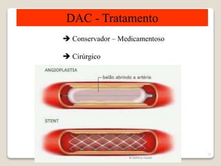 14 
DAC - Tratamento 
 Conservador – Medicamentoso 
 Cirúrgico 
 