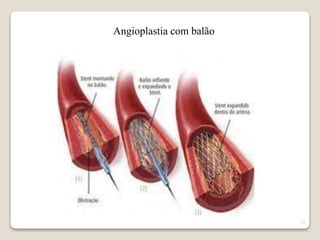 15 
Angioplastia com balão 
 
