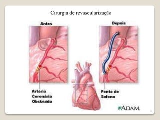 16 
Cirurgia de revascularização 
 