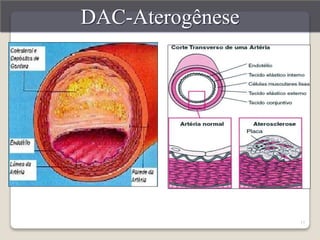 17 
DAC-Aterogênese 
 