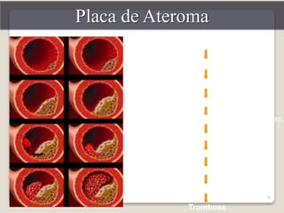 28 
Placa de Ateroma 
Acumulo de lipídios modificados 
Ativação das células endoteliais 
Migração das células inflamatórias 
Ativação das células inflamatórias 
Recrutamento das células musculares lisas 
Proliferação e síntese da matriz 
Formação da capa fibrosa 
Ruptura da placa 
Agregação das plaquetas 
Trombose 
 