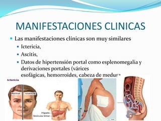 MANIFESTACIONES CLINICAS
 Las manifestaciones clínicas son muy similares
 Ictericia,
 Ascitis,
 Datos de hipertensión portal como esplenomegalia y
derivaciones portales (várices
esofágicas, hemorroides, cabeza de medusa
periumbilical, etc.)
 