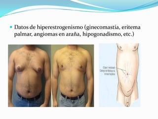  Datos de hiperestrogenismo (ginecomastia, eritema
palmar, angiomas en araña, hipogonadismo, etc.)
 