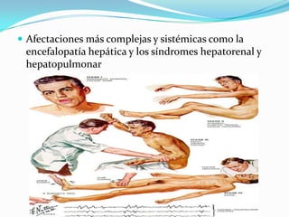  Afectaciones más complejas y sistémicas como la
encefalopatía hepática y los síndromes hepatorenal y
hepatopulmonar
 