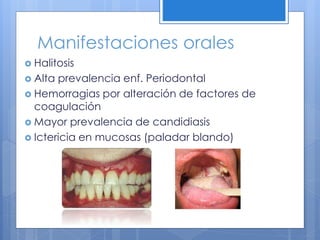 Manifestaciones orales
 Halitosis
 Alta prevalencia enf. Periodontal
 Hemorragias por alteración de factores de
coagulación
 Mayor prevalencia de candidiasis
 Ictericia en mucosas (paladar blando)
 