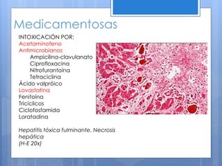 Medicamentosas
INTOXICACIÓN POR:
Acetaminofeno
Antimicrobianos
Ampicilina-clavulanato
Ciprofloxacina
Nitrofurantoína
Tetraciclina
Ácido valpróico
Lovastatina
Fenitoína
Tricíclicos
Ciclofosfamida
Loratadina
Hepatitis tóxica fulminante. Necrosis
hepática
(H-E 20x)
 