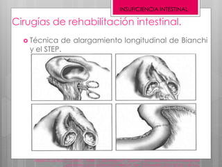 Cirugías de rehabilitación intestinal.
 Técnica de alargamiento longitudinal de Bianchi
y el STEP.
Alberti G, Le Roy C, Cofre C, Patillo J, Domínguez P, Guerra J; actualización en el manejo de
pacientes con insuficiencia intestinal; Rev Chil pediatr 2014; 85 (2): 148-156.
INSUFICIENCIA INTESTINAL
 