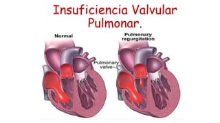 Insuficiencia Valvular 
Pulmonar. 
 