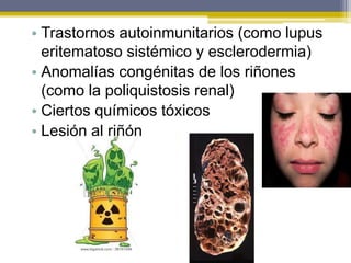 • Trastornos autoinmunitarios (como lupus
eritematoso sistémico y esclerodermia)
• Anomalías congénitas de los riñones
(como la poliquistosis renal)
• Ciertos químicos tóxicos
• Lesión al riñón
 