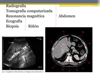 Radiografía
Tomografía computarizada
Resonancia magnética Abdomen
Ecografía
Biopsia Riñón
 