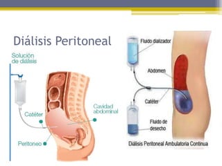 Diálisis Peritoneal
 