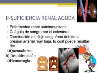 INSUFICIENCIA RENAL AGUDA
• Enfermedad renal autoinmunitaria
• Coágulo de sangre por el colesterol
• Disminución del flujo sanguíneo debido a
presión arterial muy baja, lo cual puede resultar
de:
a)Quemaduras
b) Deshidratación
c)Hemorragia
 