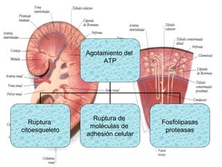 Insuficiencia Renal Aguda | PPT