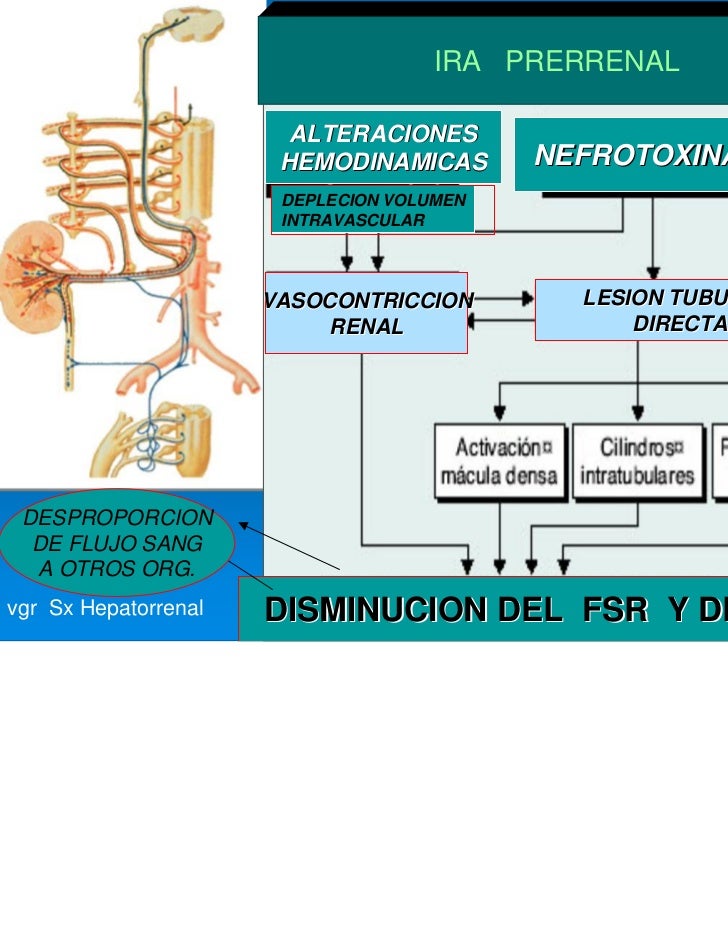 Insuficiencia renal aguda