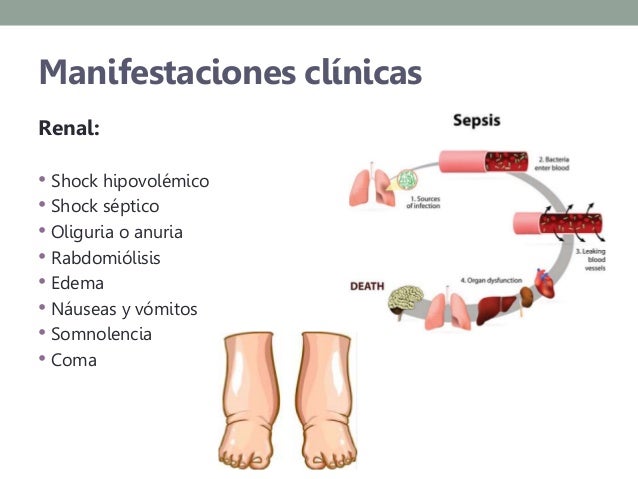 Insuficiencia renal aguda Insuficiencia renal aguda