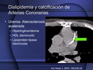 Dislipidemia y calcificación de
Arterias Coronarias
• Uremia: Aterosclerosis
acelerada
– Hipertrigliceridemia
– HDL dismin...