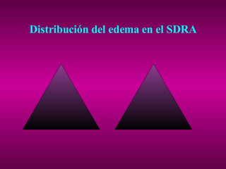 Distribución del edema en el SDRA 